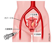 子宮と血管の図解
